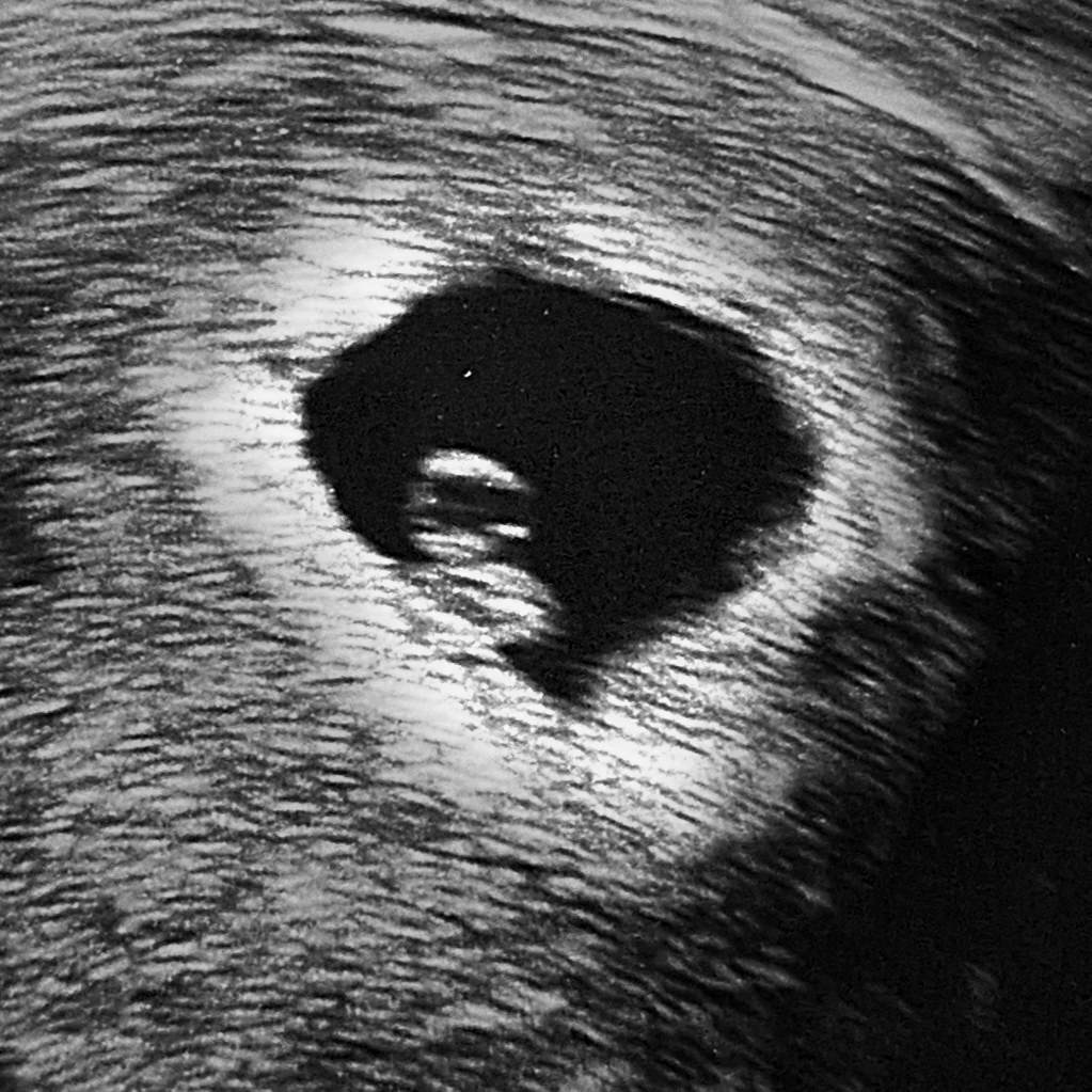 Ecografia in bianco e nero con un embrione visibile nel sacco gestazionale.